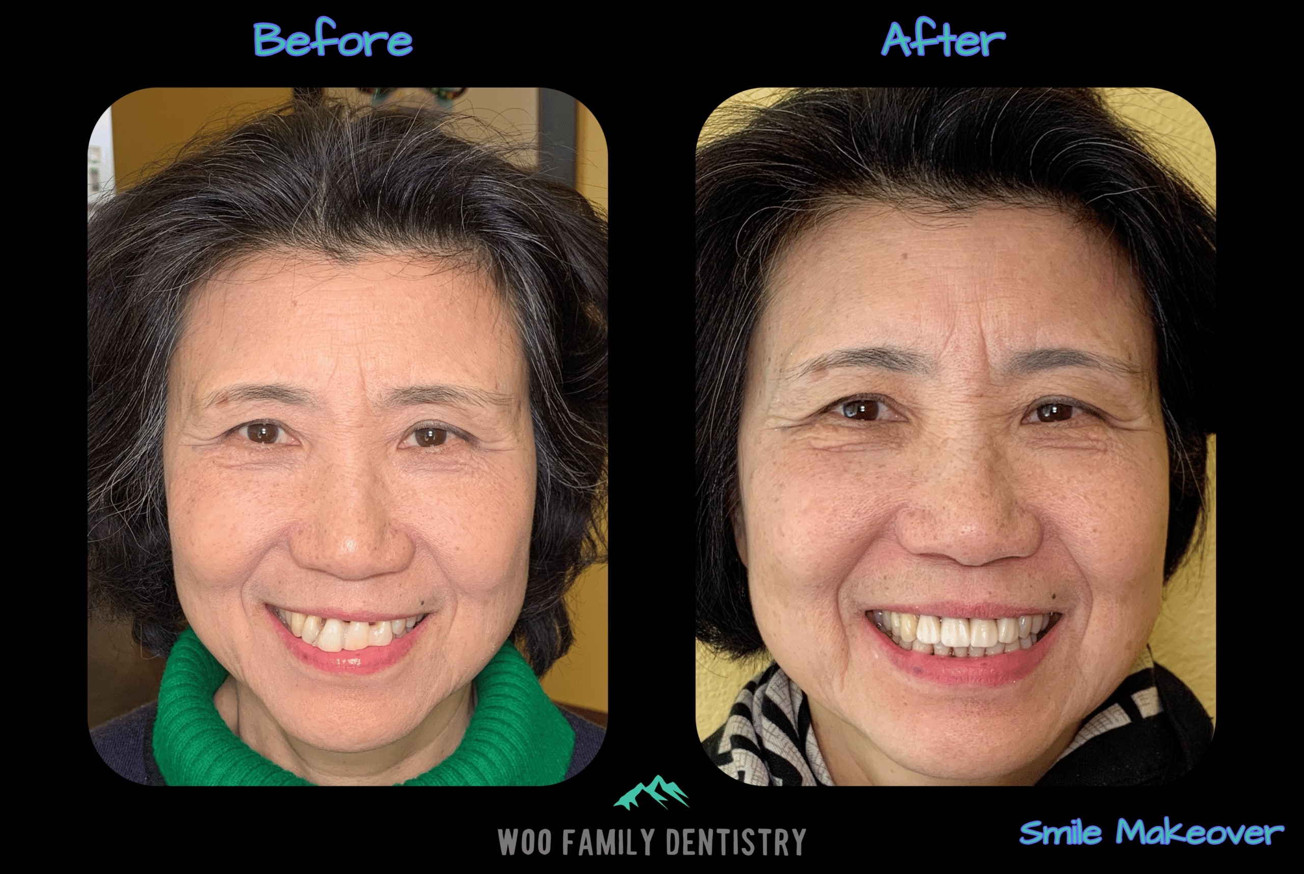 Smile Makeover Before After