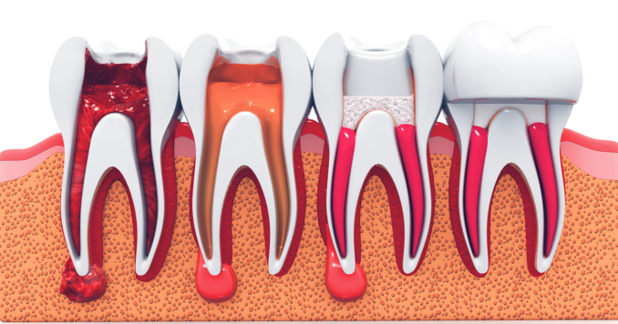 How Root Canals Can Save Your Natural Teeth?