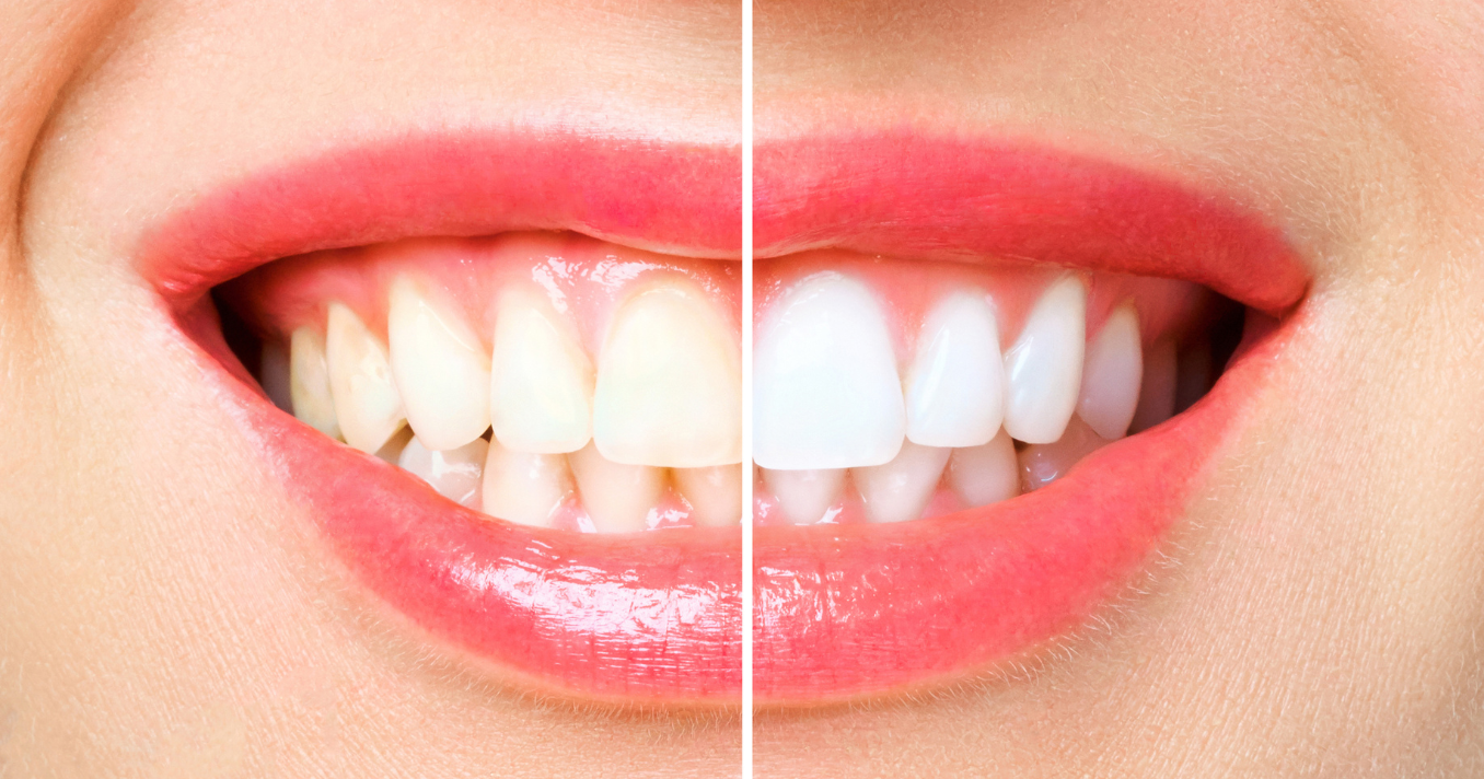 What is the Safest Way to Whiten Your Teeth?